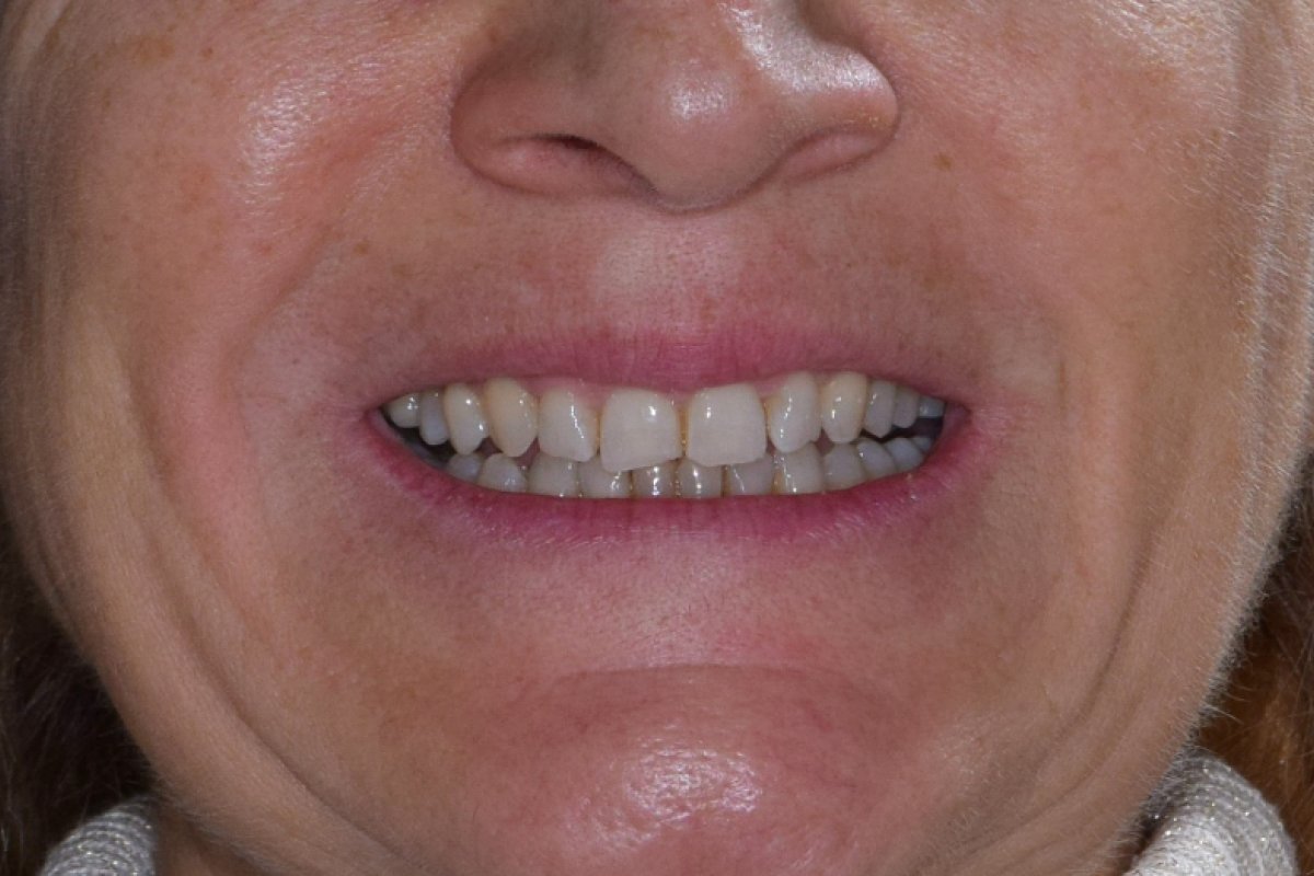 Unsichtbare Zahnspange